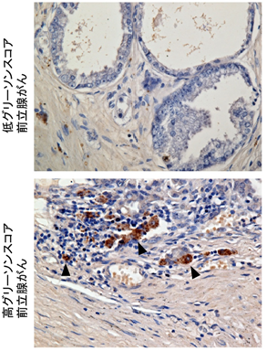 Epithelial membrane protein 1は、copine-III、Rac1を介して細胞運動を亢進させ、がんの転移を促進する