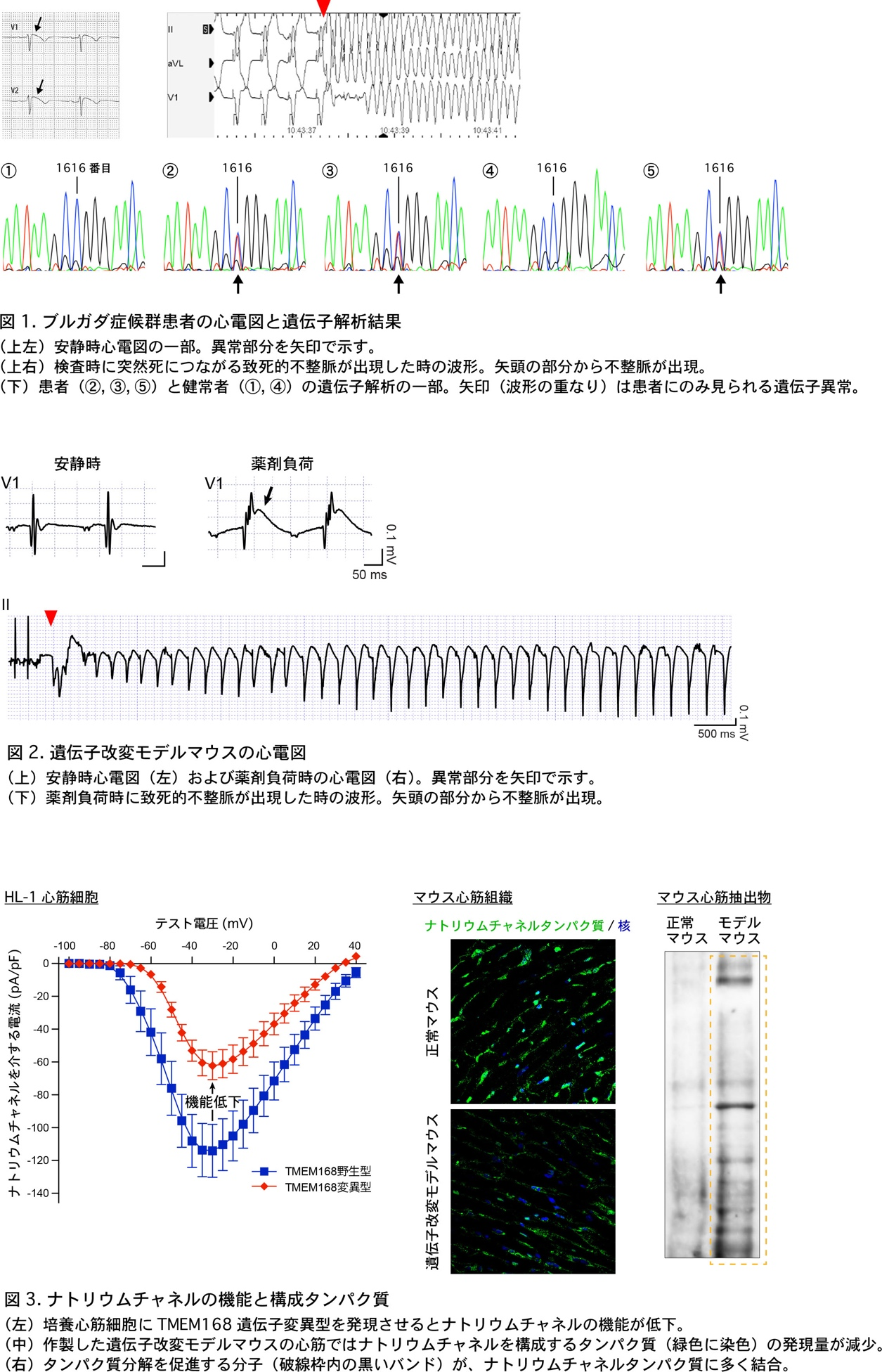 ブルガダ症候群心電図等